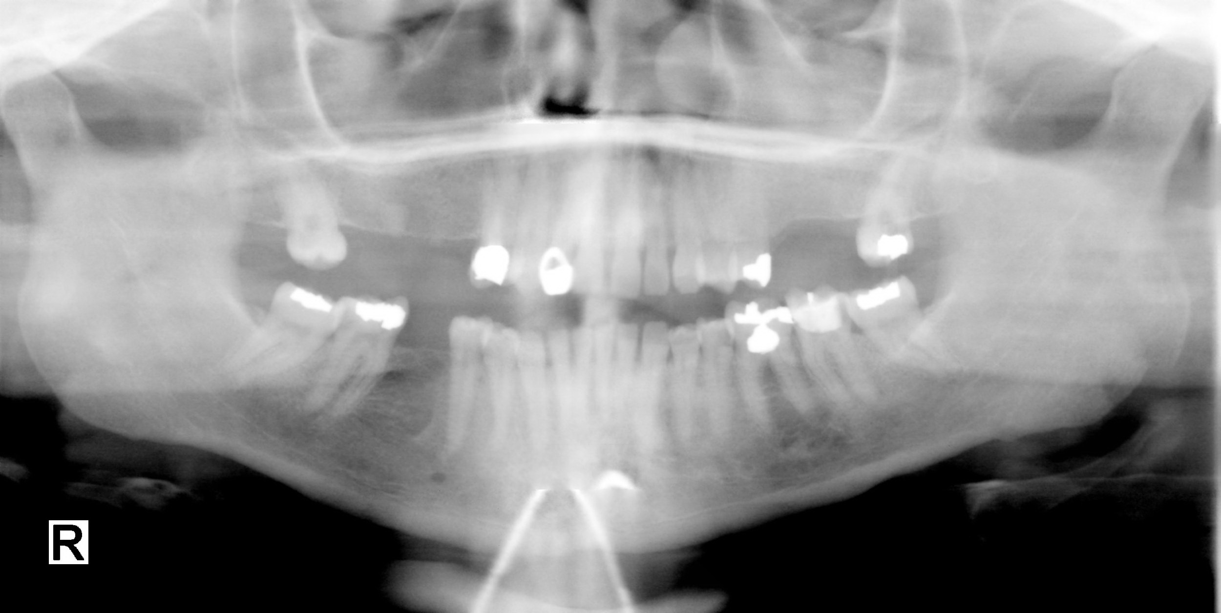 공개 파노라마 치과 X-ray 예제