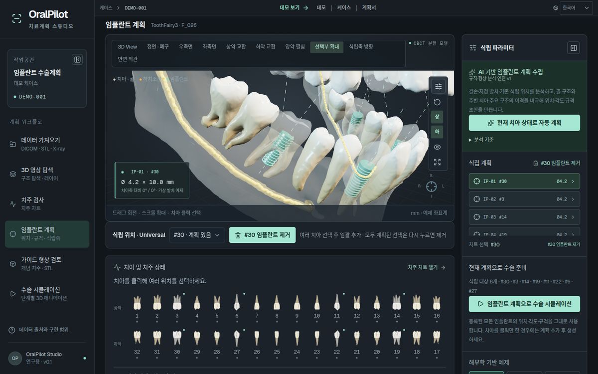 OralPilot 화면 — 식립 부위 확대